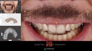 diseño digital de la sonrisa 2D